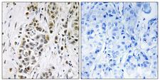 XRN2 Antibody - Immunohistochemistry analysis of paraffin-embedded human breast carcinoma tissue, using XRN2 Antibody. The picture on the right is blocked with the synthesized peptide.