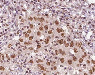 XRN2 Antibody - 1:100 staining human liver tissue by IHC-P. The tissue was formaldehyde fixed and a heat mediated antigen retrieval step in citrate buffer was performed. The tissue was then blocked and incubated with the antibody for 1.5 hours at 22°C. An HRP conjugated goat anti-rabbit antibody was used as the secondary.