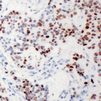 XRN2 Antibody - Immunohistochemical analysis of XRN2 staining in human breast cancer formalin fixed paraffin embedded tissue section. The section was pre-treated using heat mediated antigen retrieval with sodium citrate buffer (pH 6.0). The section was then incubated with the antibody at room temperature and detected using an HRP conjugated compact polymer system. DAB was used as the chromogen. The section was then counterstained with hematoxylin and mounted with DPX.