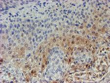 XTP4 / C17orf37 Antibody - IHC of paraffin-embedded Carcinoma of Human bladder tissue using anti-C17orf37 mouse monoclonal antibody.