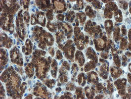 XTP4 / C17orf37 Antibody - IHC of paraffin-embedded Carcinoma of Human thyroid tissue using anti-C17orf37 mouse monoclonal antibody. (Heat-induced epitope retrieval by 10mM citric buffer, pH6.0, 100C for 10min).