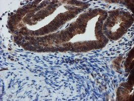 XTP4 / C17orf37 Antibody - IHC of paraffin-embedded Adenocarcinoma of Human endometrium tissue using anti-C17orf37 mouse monoclonal antibody. (Heat-induced epitope retrieval by 10mM citric buffer, pH6.0, 100C for 10min).