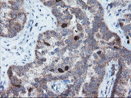 XTP4 / C17orf37 Antibody - IHC of paraffin-embedded Adenocarcinoma of Human ovary tissue using anti-C17orf37 mouse monoclonal antibody. (Heat-induced epitope retrieval by 10mM citric buffer, pH6.0, 100C for 10min).