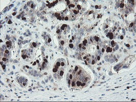 XTP4 / C17orf37 Antibody - IHC of paraffin-embedded Carcinoma of Human pancreas tissue using anti-C17orf37 mouse monoclonal antibody. (Heat-induced epitope retrieval by 10mM citric buffer, pH6.0, 100C for 10min).