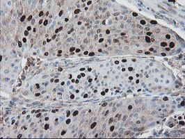 XTP4 / C17orf37 Antibody - IHC of paraffin-embedded Carcinoma of Human bladder tissue using anti-C17orf37 mouse monoclonal antibody. (Heat-induced epitope retrieval by 10mM citric buffer, pH6.0, 100C for 10min).