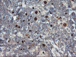 XTP4 / C17orf37 Antibody - IHC of paraffin-embedded Human lymphoma tissue using anti-C17orf37 mouse monoclonal antibody. (Heat-induced epitope retrieval by 10mM citric buffer, pH6.0, 100C for 10min).