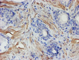 XTP4 / C17orf37 Antibody - IHC of paraffin-embedded Carcinoma of Human prostate tissue using anti-C17orf37 mouse monoclonal antibody. (Heat-induced epitope retrieval by 10mM citric buffer, pH6.0, 100C for 10min).
