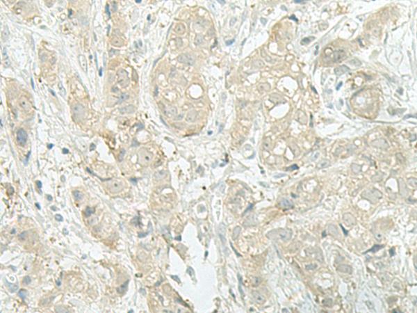 XTP4 / C17orf37 Antibody - Immunohistochemistry of paraffin-embedded Human breast cancer tissue  using MIEN1 Polyclonal Antibody at dilution of 1:45(×200)