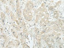 XTP4 / C17orf37 Antibody - Immunohistochemistry of paraffin-embedded Human breast cancer tissue  using MIEN1 Polyclonal Antibody at dilution of 1:45(×200)