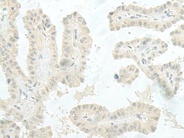 XTP4 / C17orf37 Antibody - Immunohistochemistry of paraffin-embedded Human thyroid cancer tissue  using MIEN1 Polyclonal Antibody at dilution of 1:45(×200)