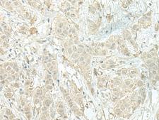 XTP4 / C17orf37 Antibody - Immunohistochemistry of paraffin-embedded Human breast cancer tissue  using MIEN1 Polyclonal Antibody at dilution of 1:100(×200)