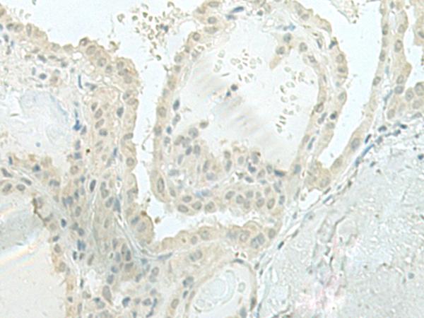 XTP4 / C17orf37 Antibody - Immunohistochemistry of paraffin-embedded Human thyroid cancer tissue  using MIEN1 Polyclonal Antibody at dilution of 1:100(×200)