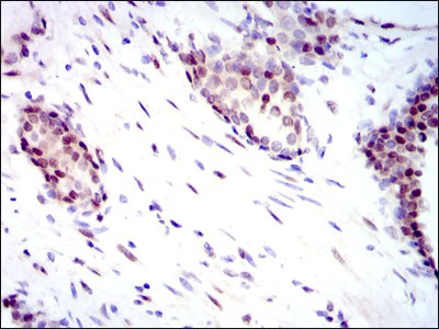 YAP / YAP1 Antibody - Immunohistochemistry-Paraffin: YAP1 Antibody (1A12) - Immunohistochemical analysis of paraffin-embedded prostate cancer tissues using YAP1 mouse mAb with DAB staining.