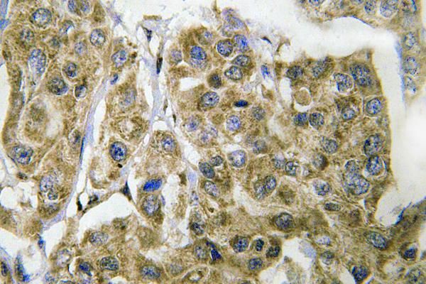 YAP / YAP1 Antibody - IHC of YAP (Q295) pAb in paraffin-embedded human breast carcinoma tissue.