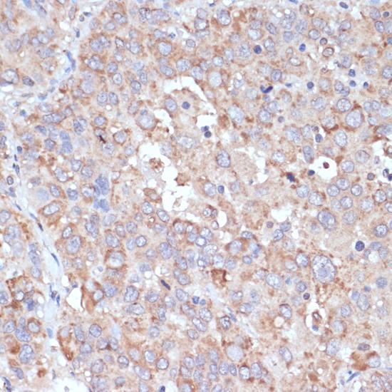 YAP / YAP1 Antibody - Immunohistochemistry of paraffin-embedded Human liver cancer using YAP1 Polyclonal Antibody at dilution of 1:100 (40x lens).