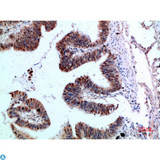 YARS / Tyrosyl-tRNA Synthetase Antibody - Immunohistochemical analysis of paraffin-embedded human-colon-cancer, antibody was diluted at 1:200.