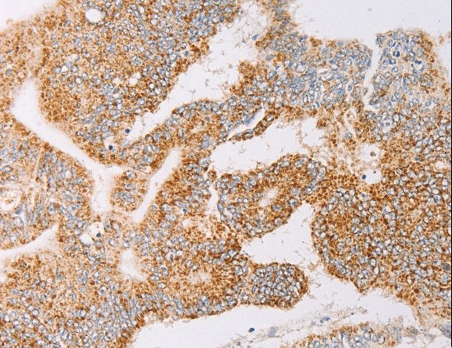 YARS2 Antibody - Immunohistochemistry of paraffin-embedded Human lung cancer using YARS2 Polyclonal Antibody at dilution of 1:30.