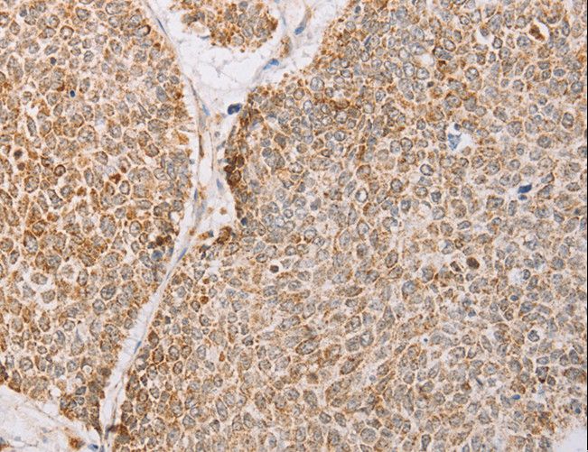 YARS2 Antibody - Immunohistochemistry of paraffin-embedded Human lung cancer using YARS2 Polyclonal Antibody at dilution of 1:30.