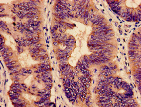 YBEY / C21orf57 Antibody - Immunohistochemistry analysis of human colon cancer at a dilution of 1:100