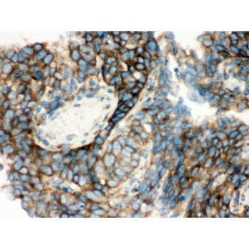YBX1 / YB1 Antibody - YB1 antibody IHC-paraffin. IHC(P): Human Lung Cancer Tissue.