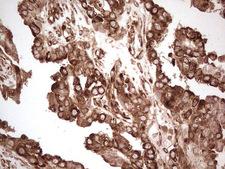 YBX1 / YB1 Antibody - Immunohistochemical staining of paraffin-embedded Adenocarcinoma of Human ovary tissue using anti-YBX1 mouse monoclonal antibody. (Heat-induced epitope retrieval by 1 mM EDTA in 10mM Tris, pH8.5, 120C for 3min,