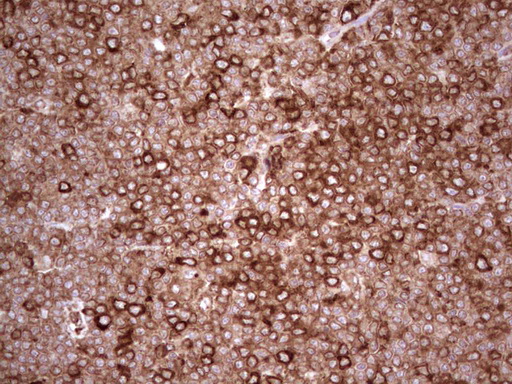 YBX1 / YB1 Antibody - Immunohistochemical staining of paraffin-embedded Human lymphoma tissue using anti-YBX1 mouse monoclonal antibody. (Heat-induced epitope retrieval by 1 mM EDTA in 10mM Tris, pH8.5, 120C for 3min,
