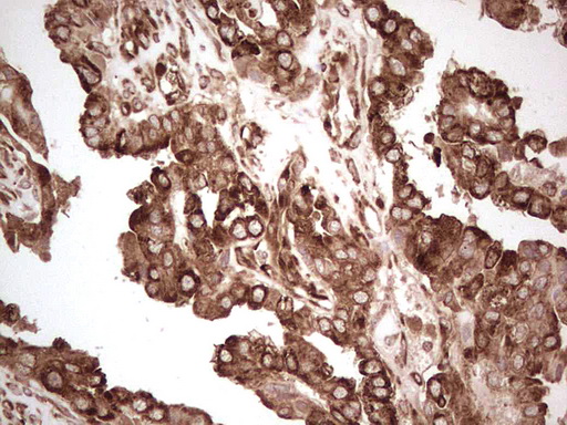 YBX1 / YB1 Antibody - IHC of paraffin-embedded Adenocarcinoma of Human ovary tissue using anti-YBX1 mouse monoclonal antibody. (Heat-induced epitope retrieval by 1 mM EDTA in 10mM Tris, pH8.5, 120°C for 3min).