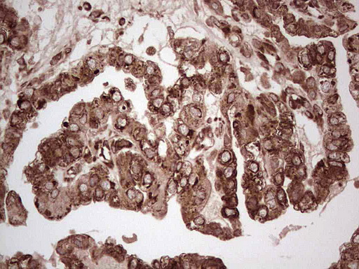 YBX1 / YB1 Antibody - Immunohistochemical staining of paraffin-embedded Adenocarcinoma of Human ovary tissue using anti-YBX1 mouse monoclonal antibody. (Heat-induced epitope retrieval by 1 mM EDTA in 10mM Tris, pH8.5, 120C for 3min,