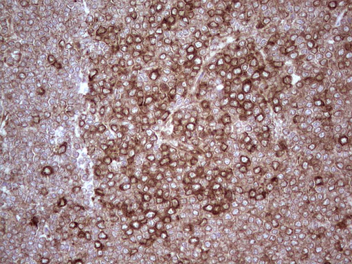 YBX1 / YB1 Antibody - Immunohistochemical staining of paraffin-embedded Human lymphoma tissue using anti-YBX1 mouse monoclonal antibody. (Heat-induced epitope retrieval by 1 mM EDTA in 10mM Tris, pH8.5, 120C for 3min,