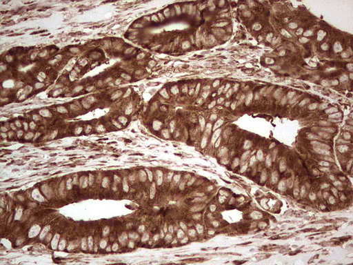 YBX1 / YB1 Antibody - Immunohistochemical staining of paraffin-embedded Adenocarcinoma of Human colon tissue using anti-YBX1 mouse monoclonal antibody. (Heat-induced epitope retrieval by 1 mM EDTA in 10mM Tris, pH8.5, 120C for 3min,
