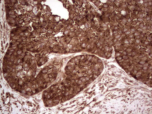 YBX1 / YB1 Antibody - Immunohistochemical staining of paraffin-embedded Carcinoma of Human kidney tissue using anti-YBX1 mouse monoclonal antibody. (Heat-induced epitope retrieval by 1 mM EDTA in 10mM Tris, pH8.5, 120C for 3min,