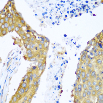 YBX1 / YB1 Antibody - Immunohistochemistry of paraffin-embedded human lung cancer tissue.