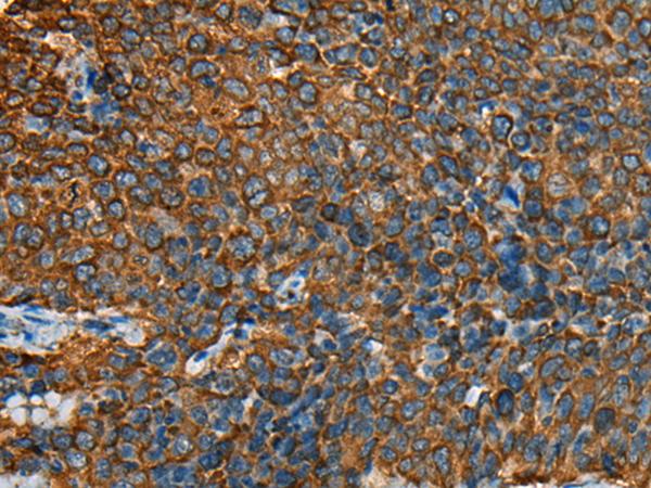 YBX1 / YB1 Antibody - Immunohistochemistry of paraffin-embedded Human cervical cancer tissue  using YBX1 Polyclonal Antibody at dilution of 1:25(×200)
