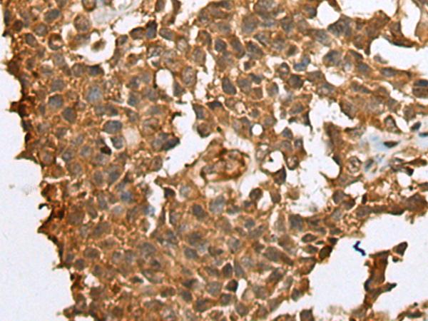 YBX1 / YB1 Antibody - Immunohistochemistry of paraffin-embedded Human ovarian cancer tissue  using YBX1 Polyclonal Antibody at dilution of 1:25(×200)