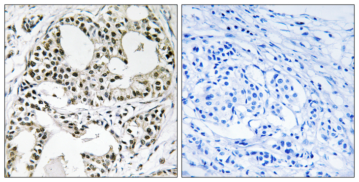 YEATS2 Antibody - Immunohistochemistry analysis of paraffin-embedded human breast carcinoma, using YEATS2 Antibody. The picture on the right is blocked with the synthesized peptide.
