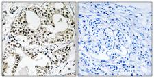 YEATS2 Antibody - Immunohistochemistry analysis of paraffin-embedded human breast carcinoma, using YEATS2 Antibody. The picture on the right is blocked with the synthesized peptide.