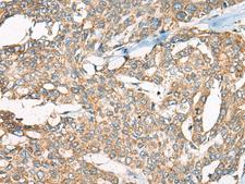 YEATS2 Antibody - Immunohistochemistry of paraffin-embedded Human liver cancer tissue  using YEATS2 Polyclonal Antibody at dilution of 1:55(×200)