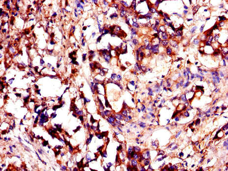 YES1 / c-Yes Antibody - Immunohistochemistry of paraffin-embedded human gastric cancer using YES1 Antibody  at dilution of 1:100