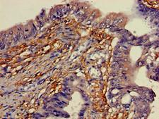 YIPF3 Antibody - Immunohistochemistry of paraffin-embedded human colon cancer using YIPF3 Antibody at dilution of 1:100