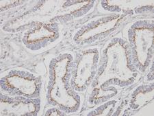 YIPF4 Antibody - IHC of paraffin-embedded Endometrial CA using YIPF4 antibody at 1:500 dilution.