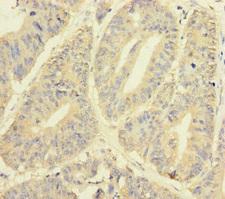 YME1L1 Antibody - Immunohistochemistry of paraffin-embedded human colon cancer at dilution of 1:100