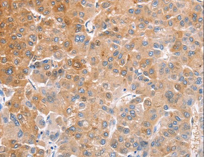 Yo / CDR2 Antibody - Immunohistochemistry of paraffin-embedded Human liver cancer using CDR2 Polyclonal Antibody at dilution of 1:60.