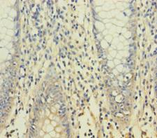 YPEL1 Antibody - Immunohistochemistry of paraffin-embedded human colon cancer using YPEL1 Antibody at dilution of 1:100
