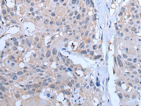YPEL5 Antibody - Immunohistochemistry of paraffin-embedded Human esophagus cancer tissue  using YPEL5 Polyclonal Antibody at dilution of 1:60(×200)