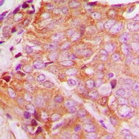 YTHDF1 Antibody - Immunohistochemical analysis of YTHDF1 staining in human breast cancer formalin fixed paraffin embedded tissue section. The section was pre-treated using heat mediated antigen retrieval with sodium citrate buffer (pH 6.0). The section was then incubated with the antibody at room temperature and detected with HRP and DAB as chromogen. The section was then counterstained with hematoxylin and mounted with DPX.