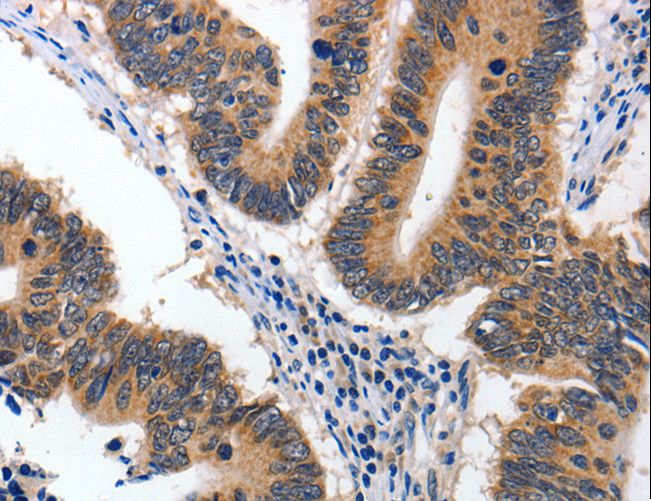 YWHAE / 14-3-3 Epsilon Antibody - Immunohistochemistry of paraffin-embedded Human colon cancer using YWHAE Polyclonal Antibody at dilution of 1:60.