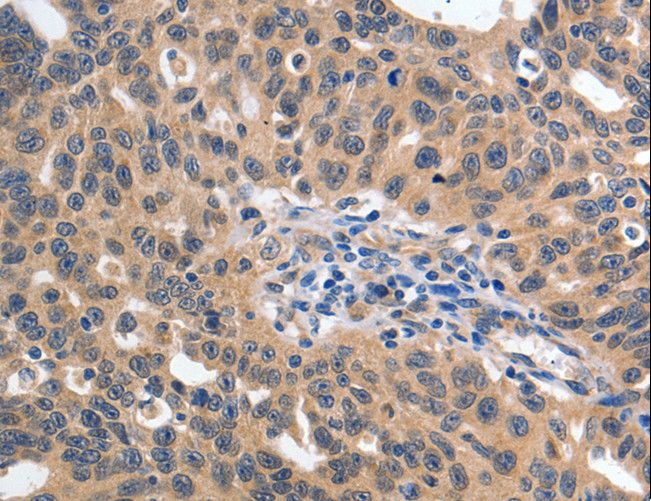 YWHAE / 14-3-3 Epsilon Antibody - Immunohistochemistry of paraffin-embedded Human ovarian cancer using YWHAE Polyclonal Antibody at dilution of 1:60.