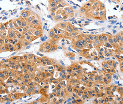 YWHAG / 14-3-3 Gamma Antibody - Immunohistochemistry of paraffin-embedded Human lung cancer tissue using YWHAG antibody.