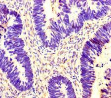 YWHAG / 14-3-3 Gamma Antibody - Immunohistochemistry of paraffin-embedded human ovarian cancer at dilution of 1:100
