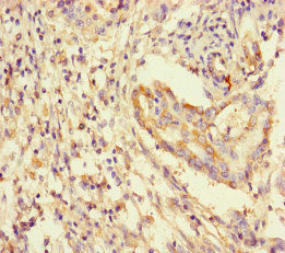YWHAG / 14-3-3 Gamma Antibody - Immunohistochemistry of paraffin-embedded human pancreatic cancer at dilution of 1:100